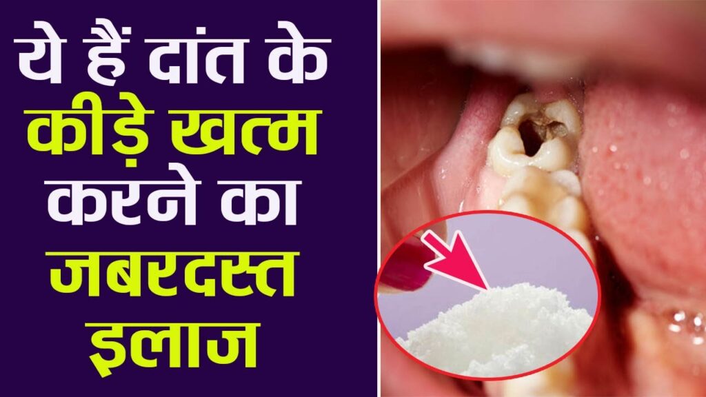 दांत के कीड़े खत्म करने का जबरदस्त इलाज | how to get rid of tooth worm | boldsky