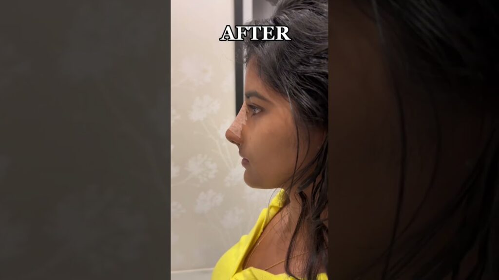 Revision rhinoplasty for my beautiful patient from india 🇮🇳🤍 #rhinoplasty #nosejob #india