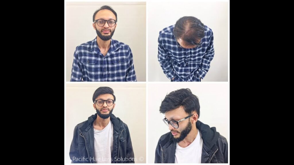 Men's undetectable thin skin poly/lace hairpiece installation with adhesive at pacific hair