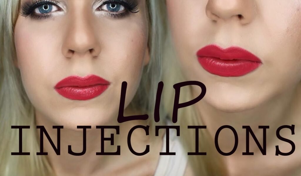 Lip injections: my story with restylane and juvederm.